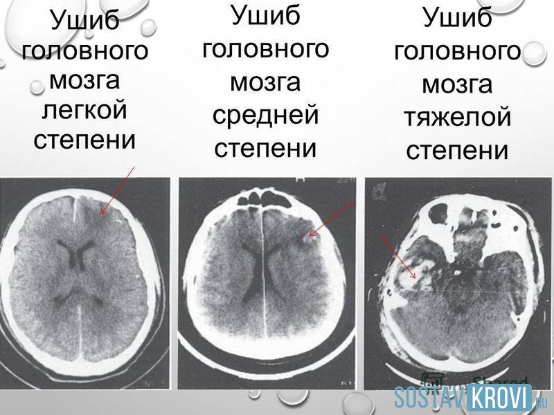Ушиб головного мозга: причины, симптомы, 1, 2, 3 степень, лечение ...