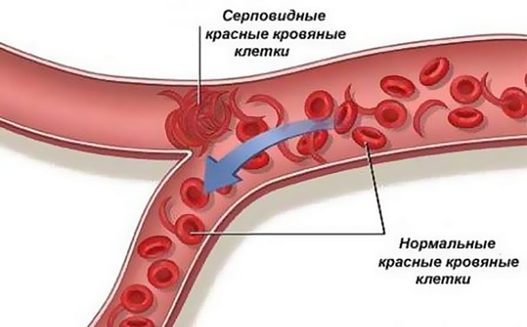 Бледность при анемии фото