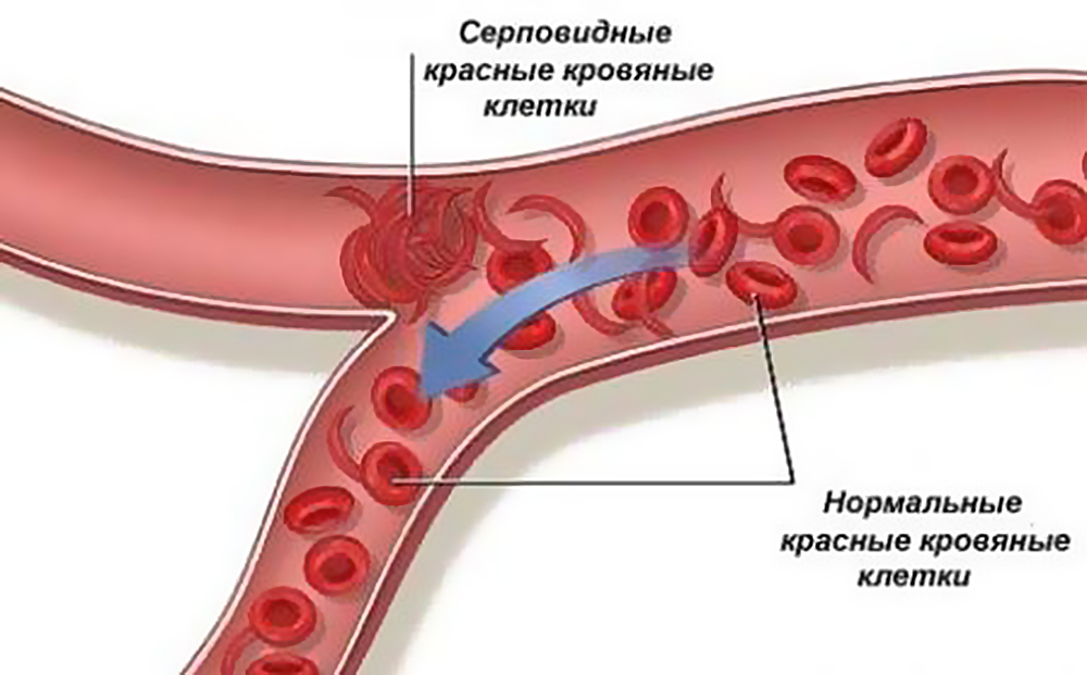 Разновидности болезни