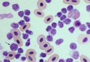 Почему повышаются моноциты в крови