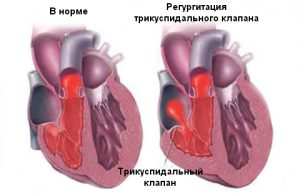 Допплерометрия трикуспидального клапана норма