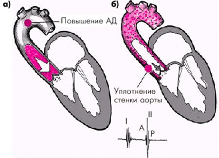 Уплотнение стенок аорты: створок аортального клапана, причины ...
