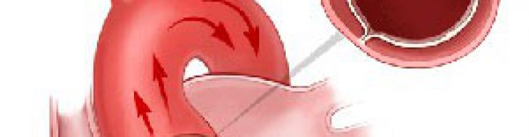 Уплотнение стенок аорты створок аортального клапана