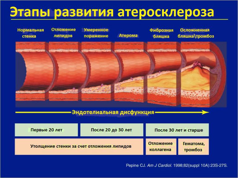 Коронарный атеросклероз в картинках