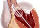 Стеноз легочной артерии у взрослых и новорожденных