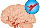 Атеросклероз и сужение сосудов головного мозга
