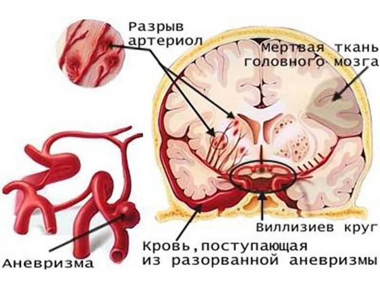 Аневризма головного мозга фото