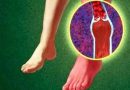 Диабетическая ангиопатия сосудов ног