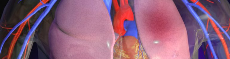 Тромбоэмболия легочной артерии (ТЭЛА)