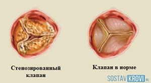 Сросшиеся клапаны в сердце