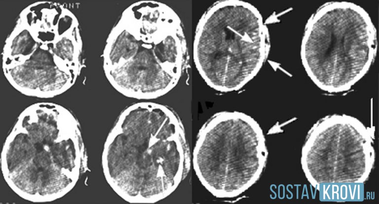 Субарахноидальное кровоизлияние головного мозга фото
