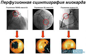 Может ли сцинтиграфия не увидеть мтс