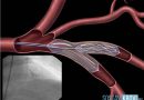 Что это такое стеноз легочной артерии