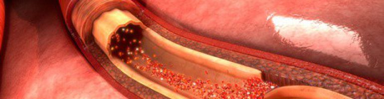 Что такое расслоение аорты