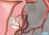 Что такое эмболизация маточных артерий