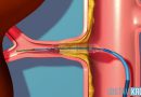 Что такое стеноз почечных артерий