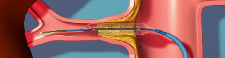 Что такое стеноз почечных артерий