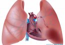 Тромбоэмболия легочной артерии (ТЭЛА)